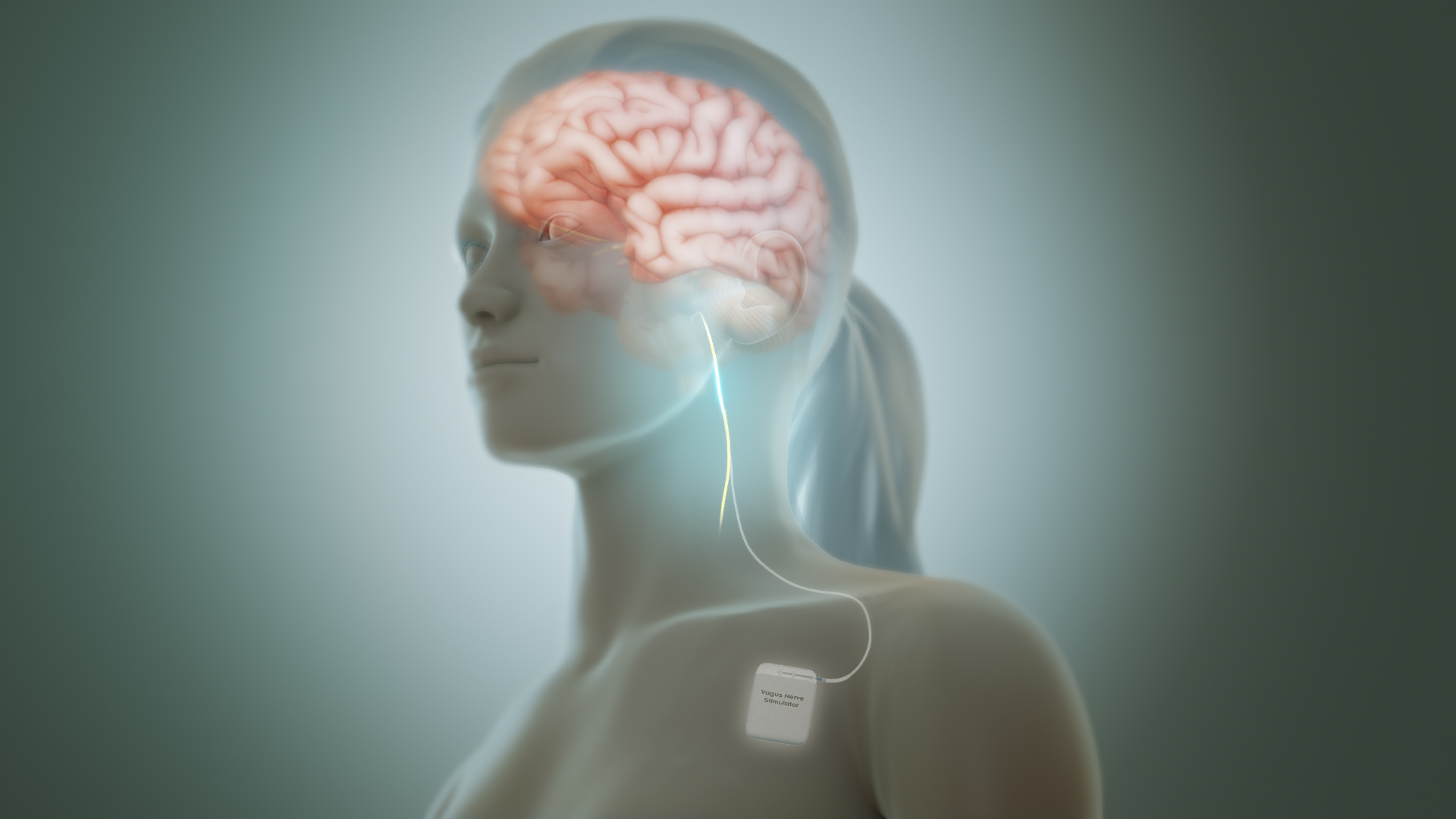 Vagus Nerve Stimulation: Fact vs TikTok Myths for Crohn's